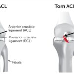 ACL