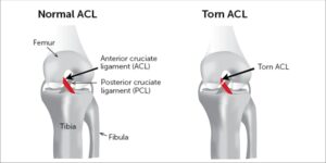 ACL