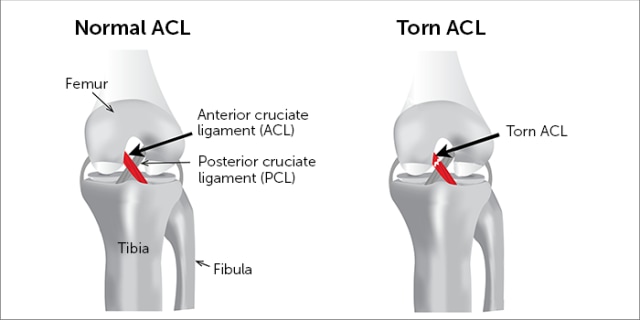 ACL